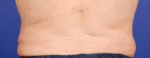 Coolsculpting of the love handles Before